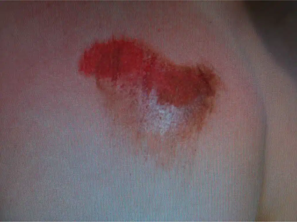 Grazed shoulder