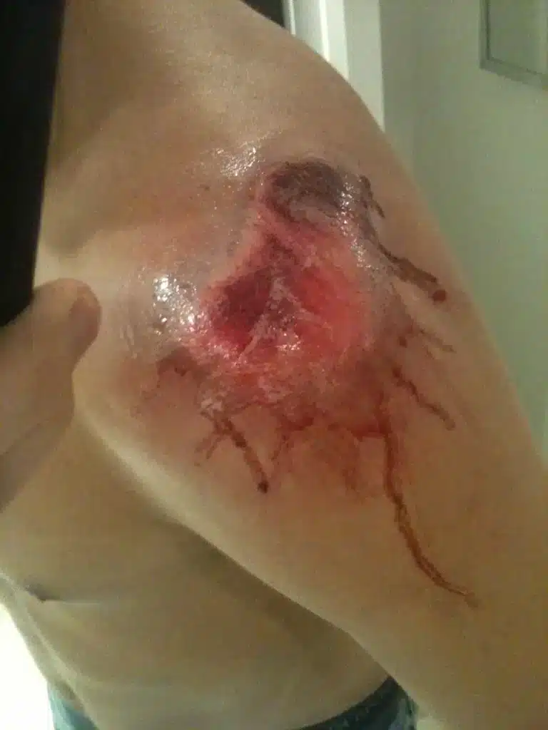 Blood covered shoulder
